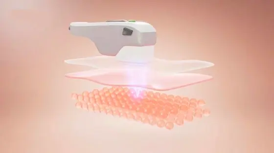 Minh họa năng lượng HIFU tác động theo điểm
