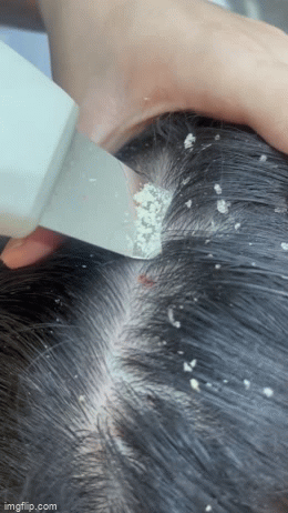 Kính hiển vi 1000X mô phỏng vi nấm Malassezia