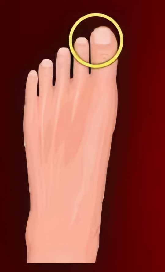 Foot A