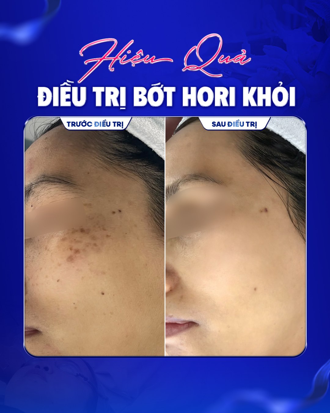 Hiệu quả điều trị Bớt Hori — trước và sau
