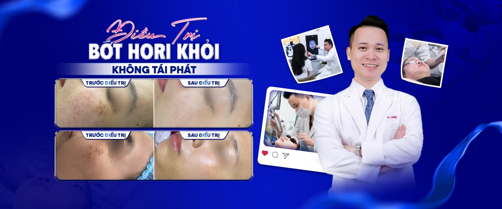 Điều trị Bớt Hori khỏi không tái phát tại S Beauty