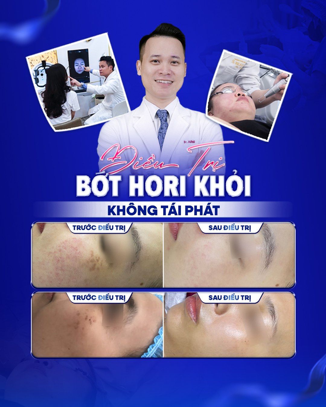 Điều trị Bớt Hori khỏi không tái phát tại S Beauty