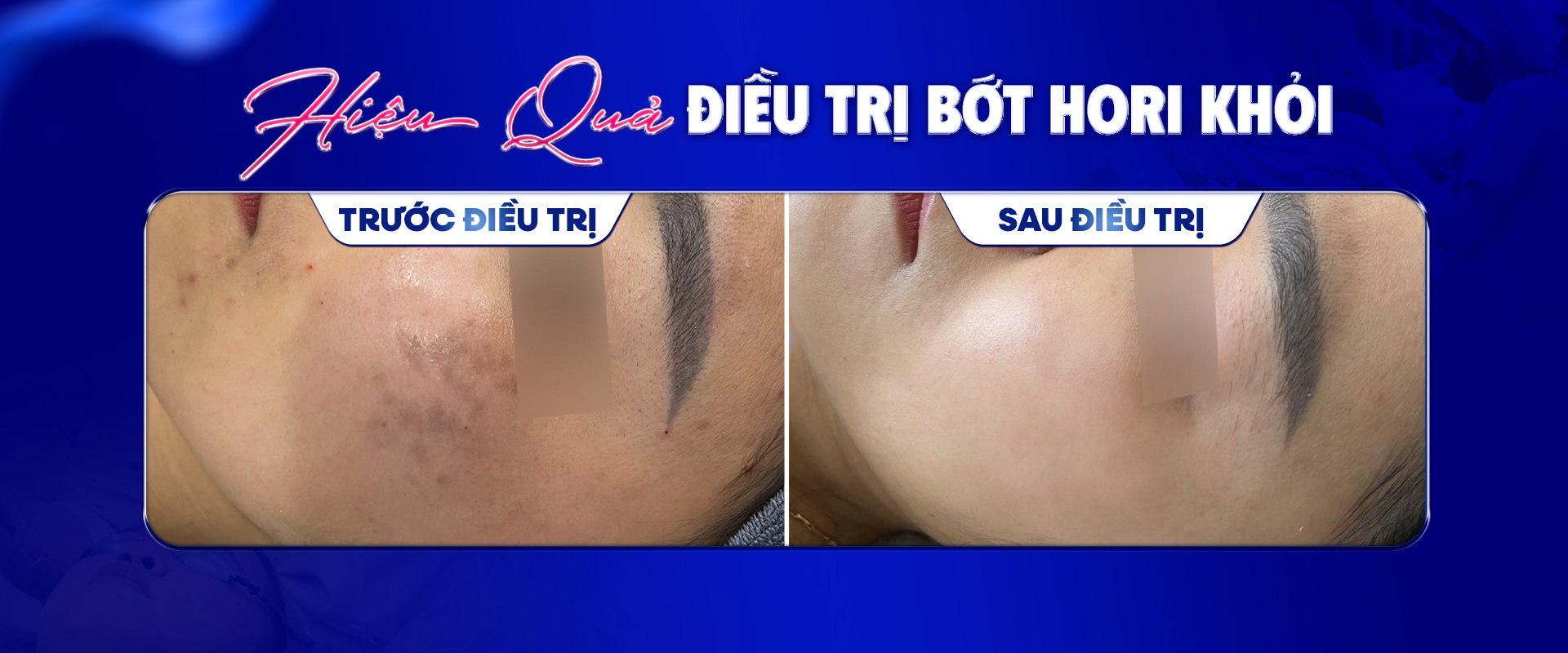 Hiệu quả điều trị Bớt Hori — trước và sau