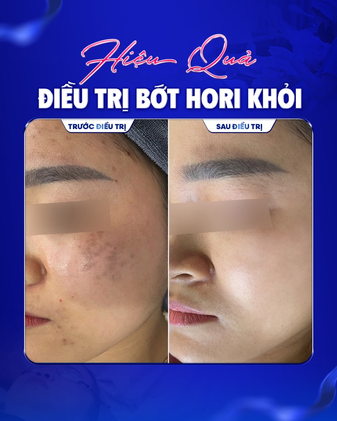 Hiệu quả điều trị Bớt Hori — trước và sau