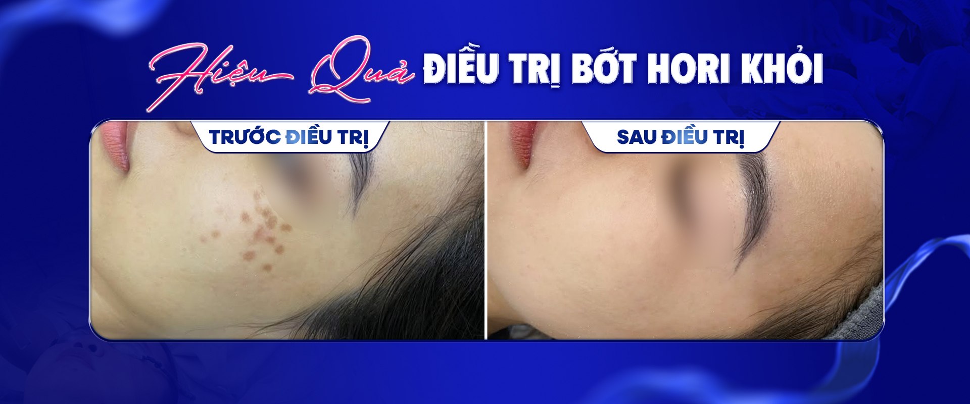 Hiệu quả điều trị Bớt Hori — trước và sau