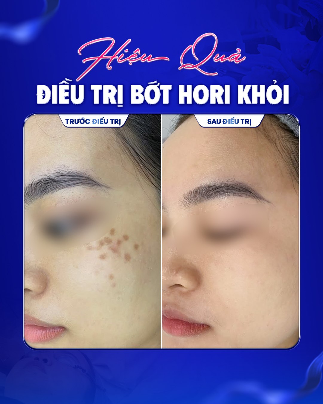 Hiệu quả điều trị Bớt Hori — trước và sau