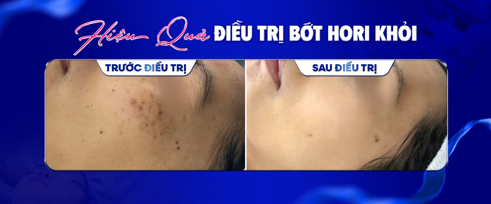 Hiệu quả điều trị Bớt Hori — trước và sau