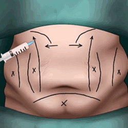 Illustration of abdominal surgery markings