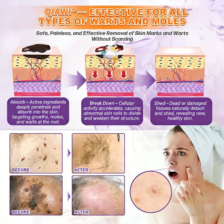 Moles warts skin appearance