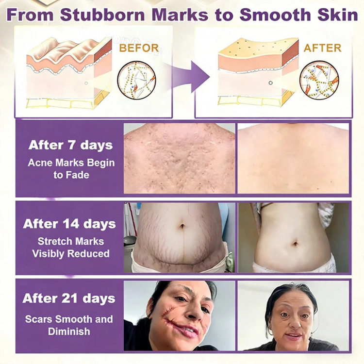 Scars stretch marks acne marks