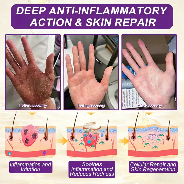 Psoriasis dry flaky irritated skin