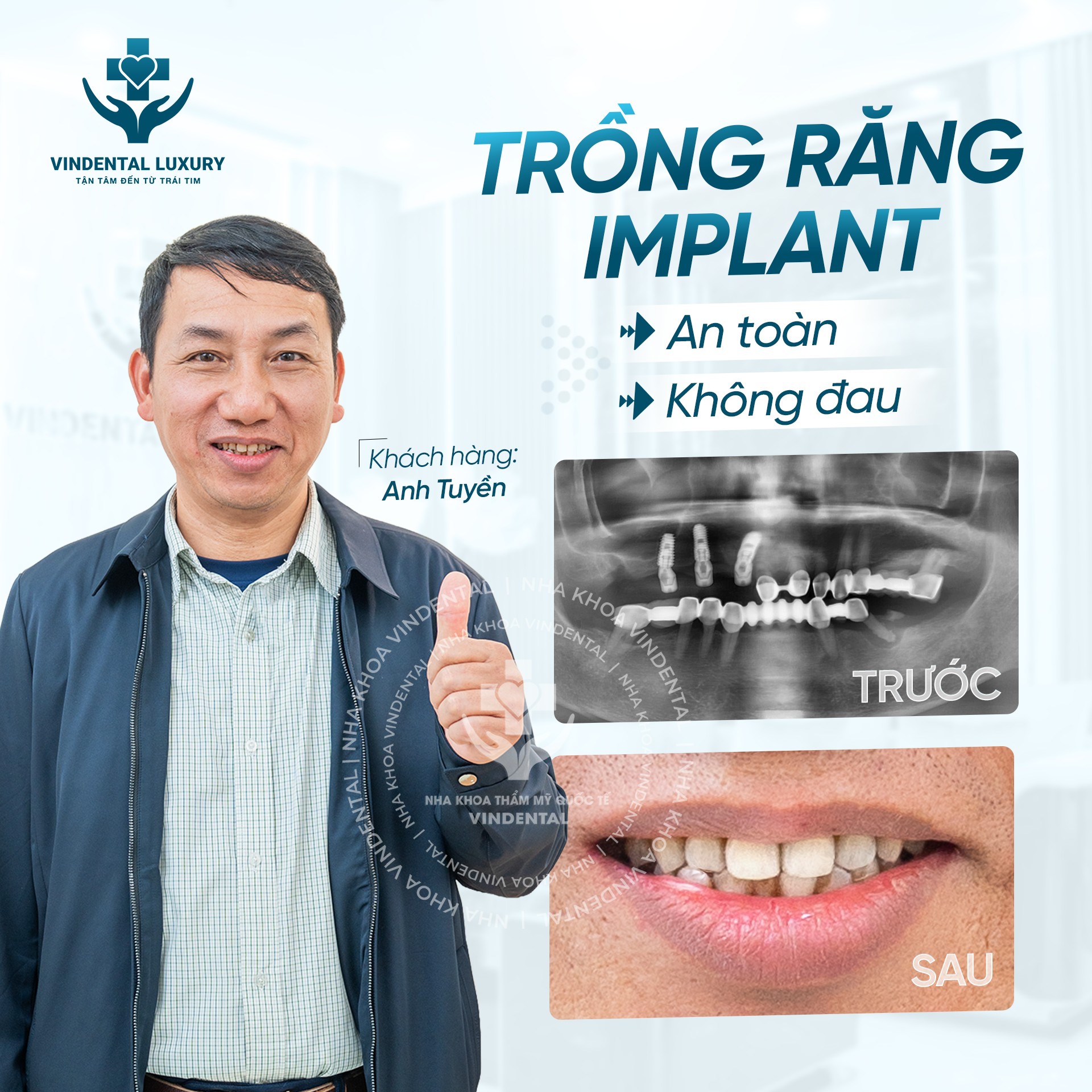 Feedback trồng Implant - khách hàng Trần Bích Hồng