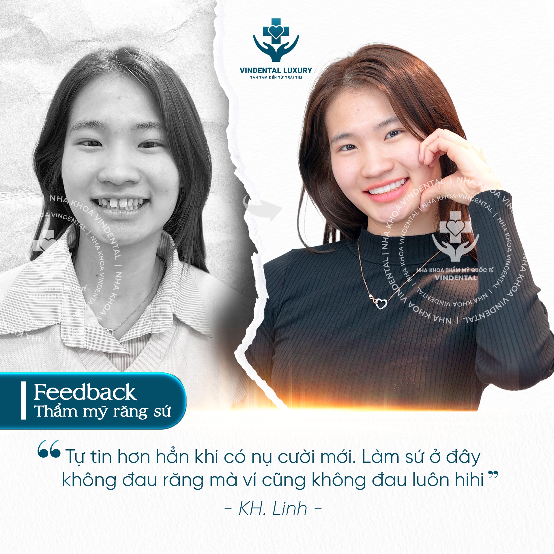 Feedback bọc sứ - khách hàng Thu Huyền