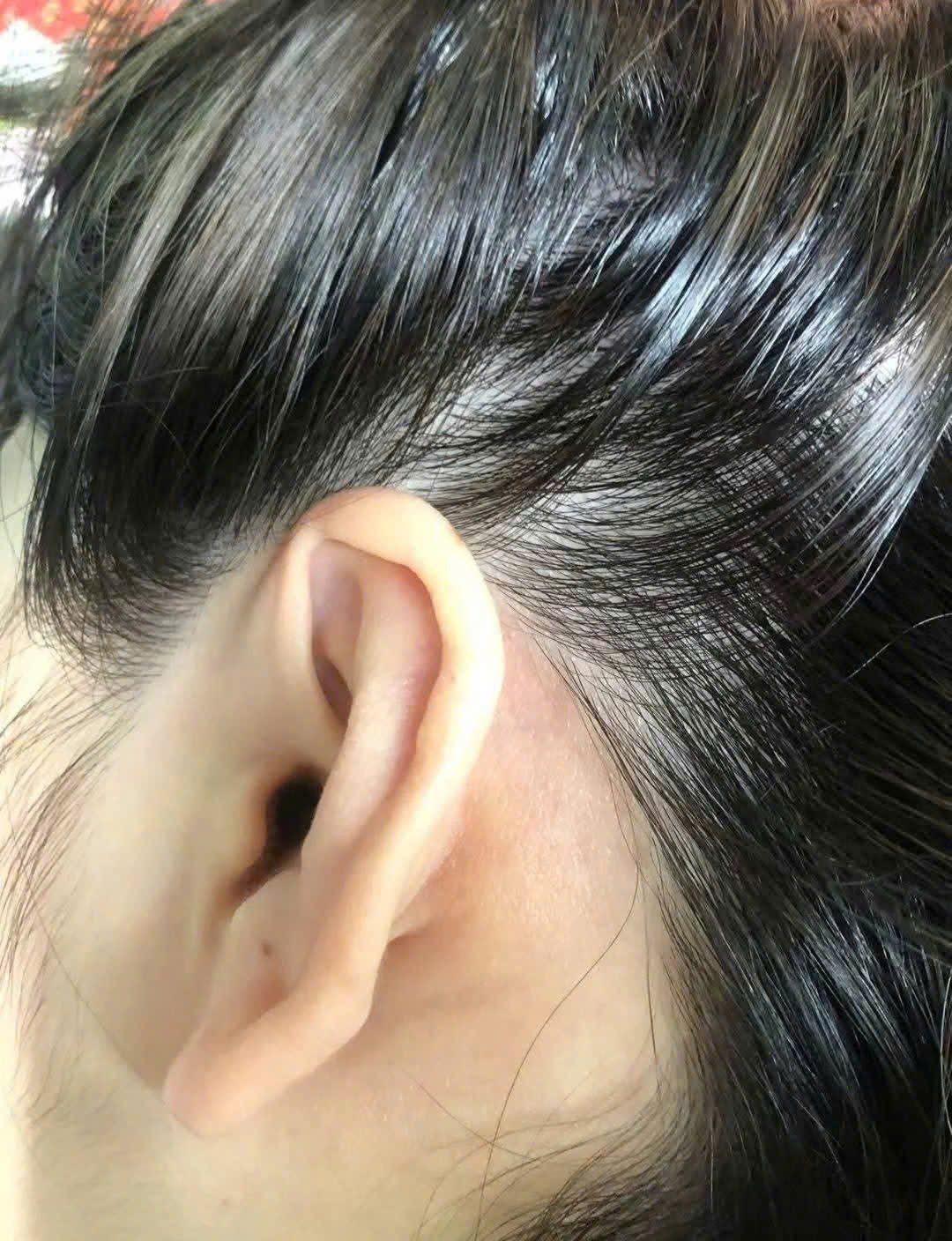 Sau điều trị: Sạch bong sau tai