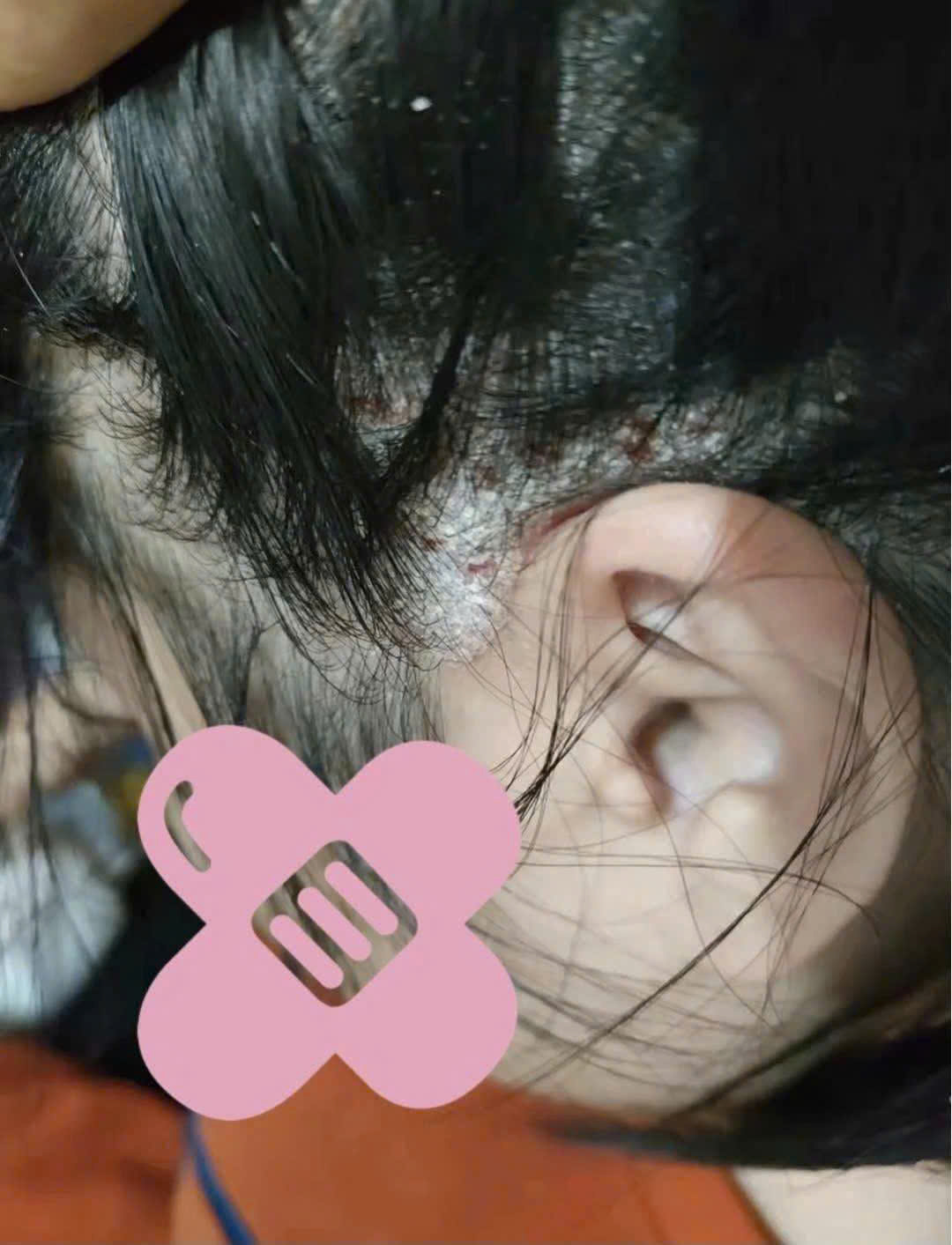 Đỏ rát lan sau tai