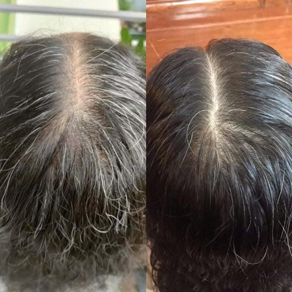 Sau điều trị: Tóc con mọc kín đường ngôi