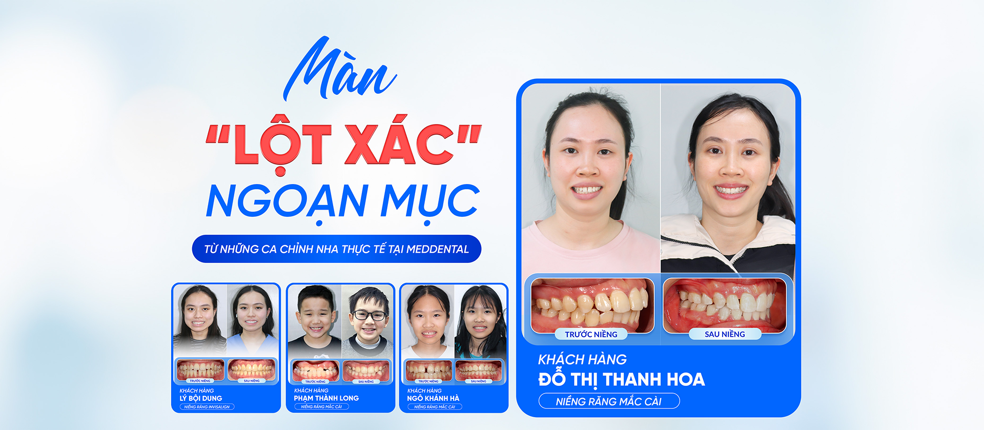 Kết quả chỉnh nha thực tế