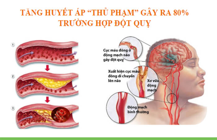 Tăng huyết áp dẫn đến đột quỵ