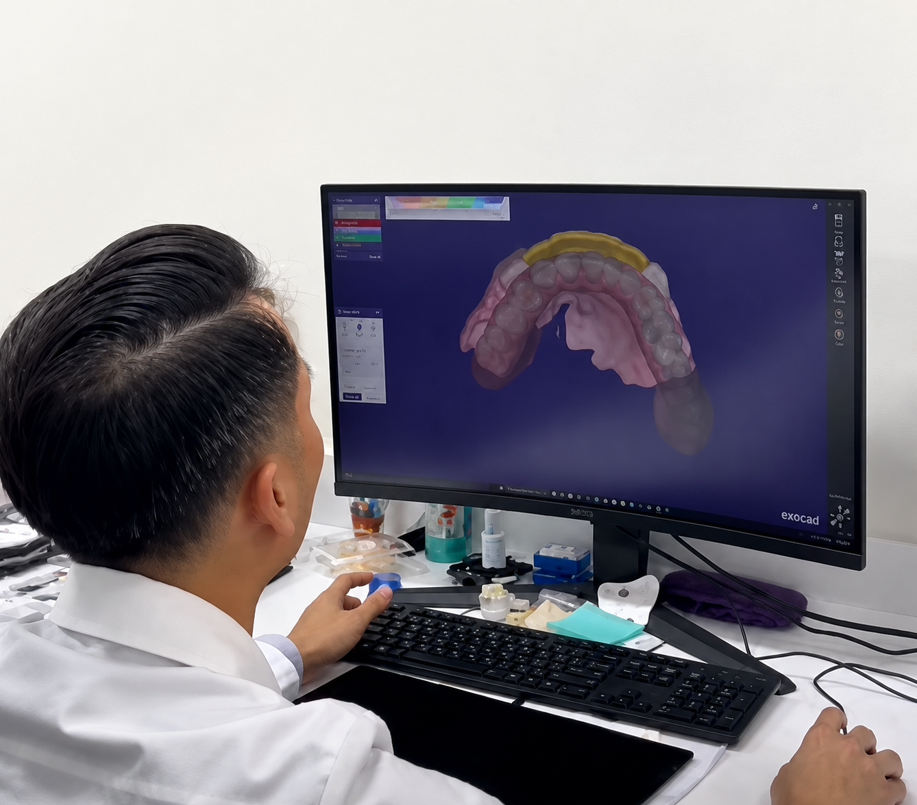 Upper Palate-Free Snap-In Dentures