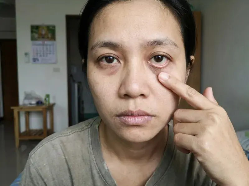 ผู้หญิงหน้าซีด ดึงเปลือกตาล่างให้เห็นว่าซีด