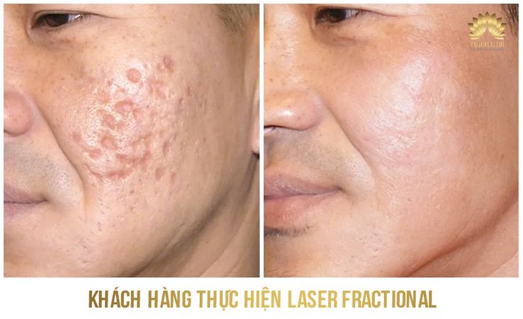 Kết quả trị sẹo 6