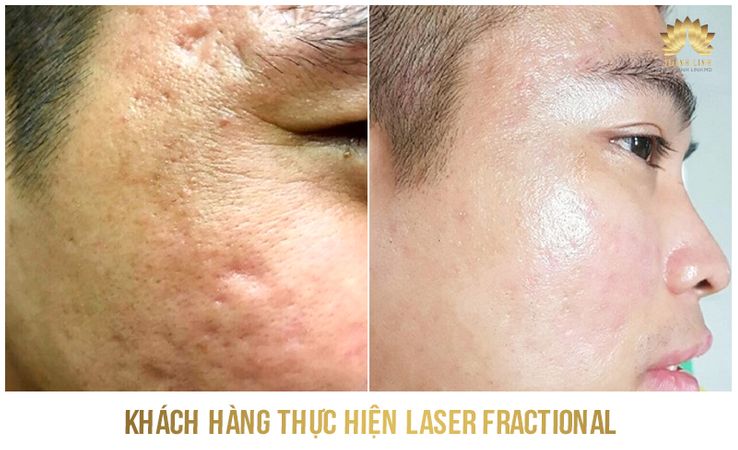 Kết quả trị sẹo 1