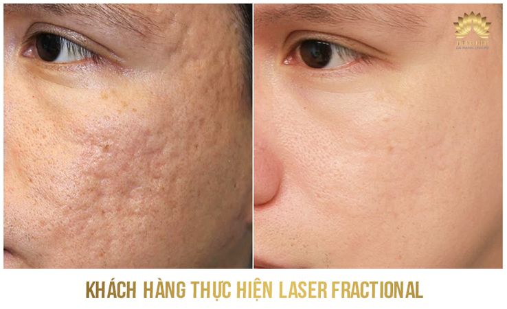Kết quả trị sẹo 2