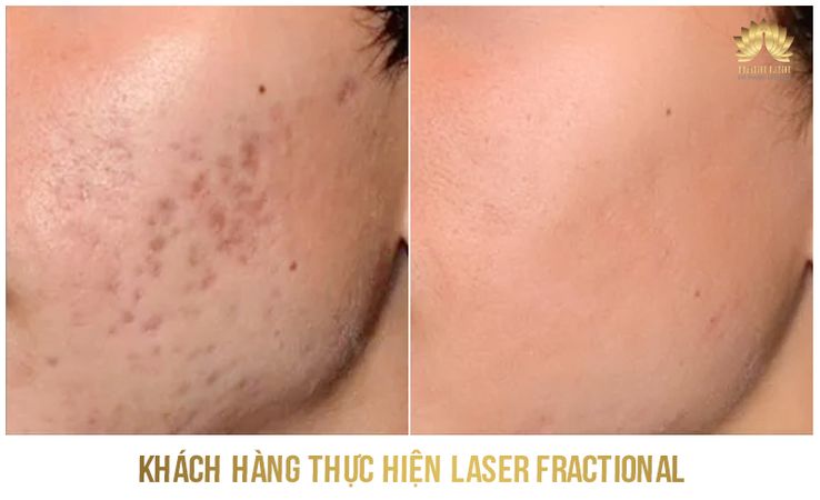 Kết quả trị sẹo 3