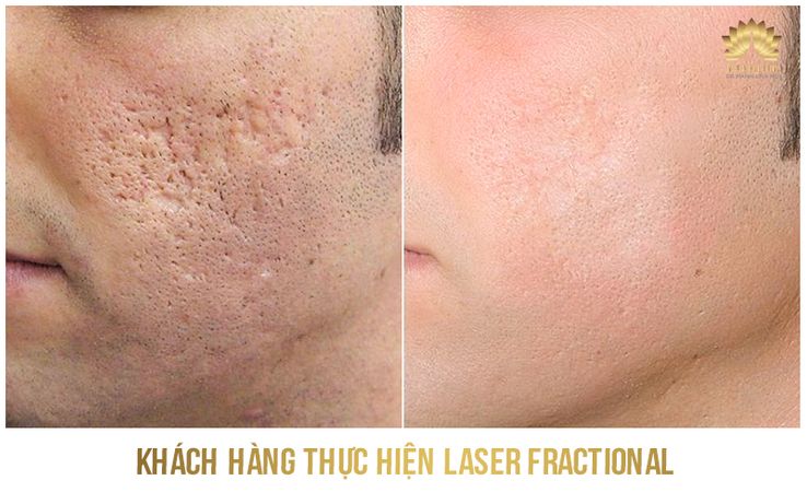 Kết quả trị sẹo 4
