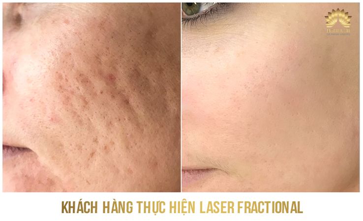 Kết quả trị sẹo 5