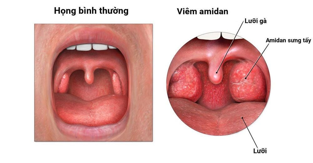 Viêm họng cấp