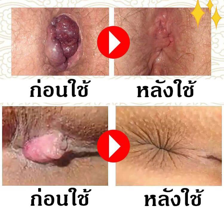 Hanoxol ป้องกันริดสีดวงทวาร: สั่งซื้อออนไลน์ง่าย ๆ